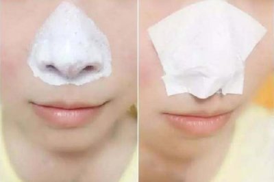 ​去黑头后用什么修复 去黑头后可以用爽肤水收缩毛孔吗