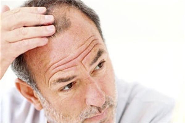 脱发是缺少什么维生素 脱发是什么原因导致的 脱发是缺少什么维生素 脱发是什么原因导致的