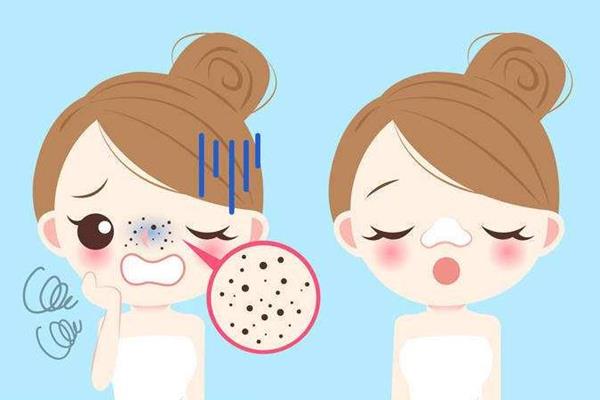 黑头要定期清理吗 黑头多久清理一次比较好 黑头要定期清理吗 黑头多久清理一次比较好