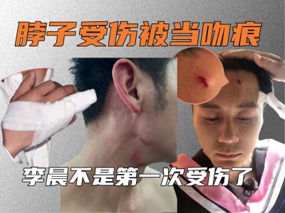 ​李晨脖子受伤被当吻痕，工作室发声否认，其实他不是第一次受伤了